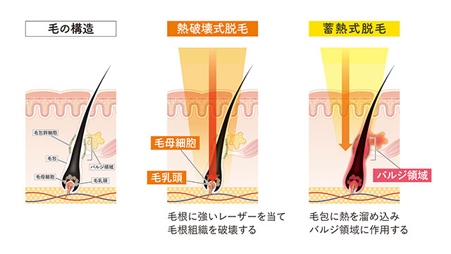 熱破壊式の医療レーザー脱毛機